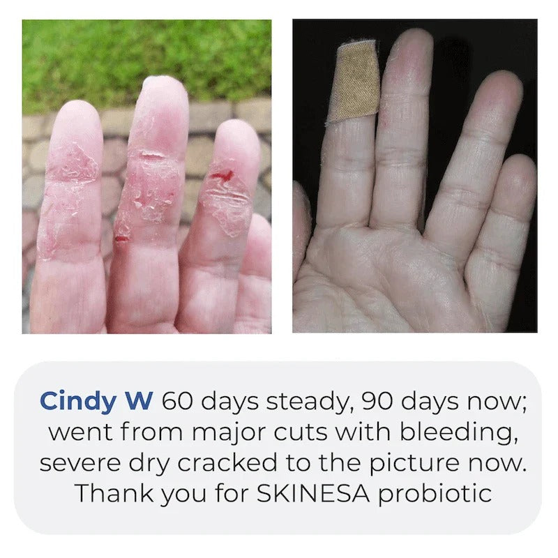 Skinesa Skin Probiotic