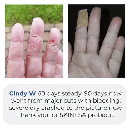 Skinesa Skin Probiotic